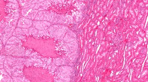 Kidney cancer cells (left) and normal kidney cells (right)